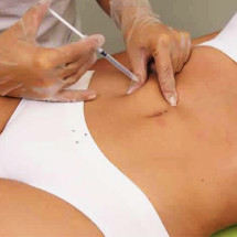 Mesoterapia